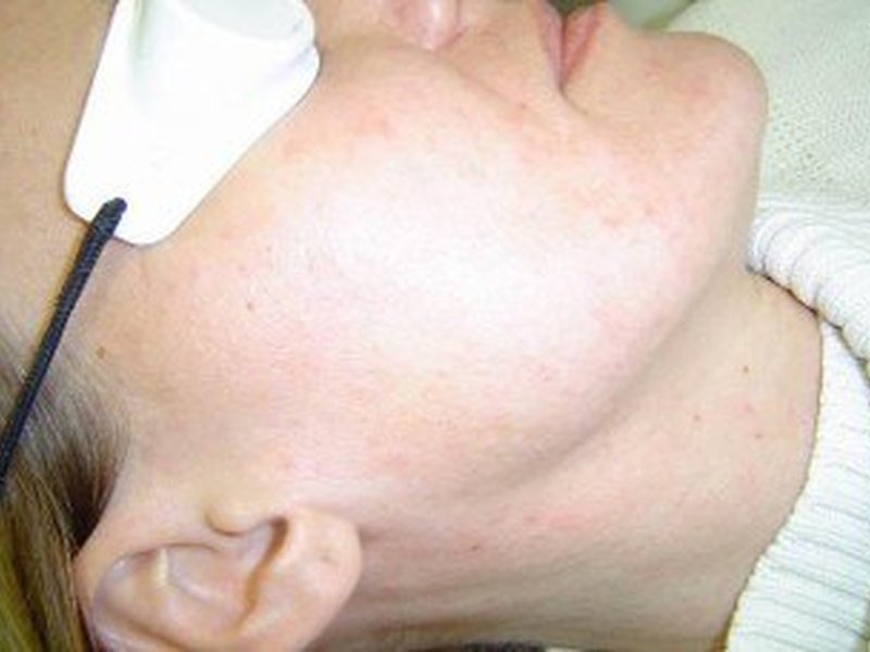 Акне и постакне — acne after