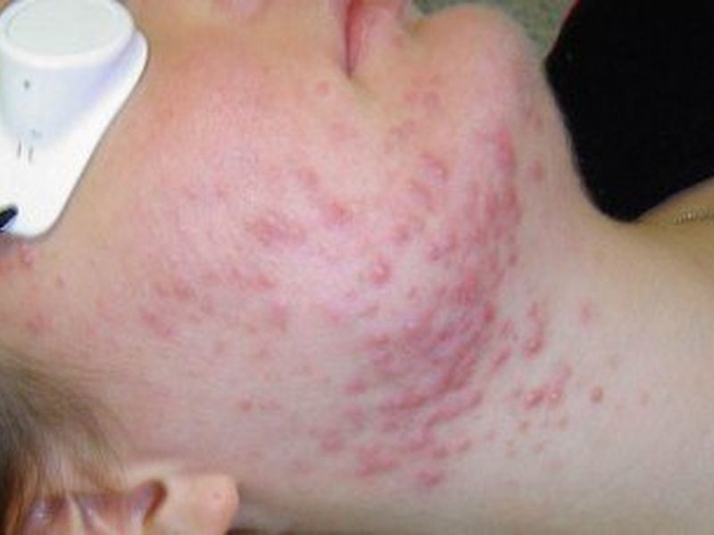 Акне и постакне — acne before