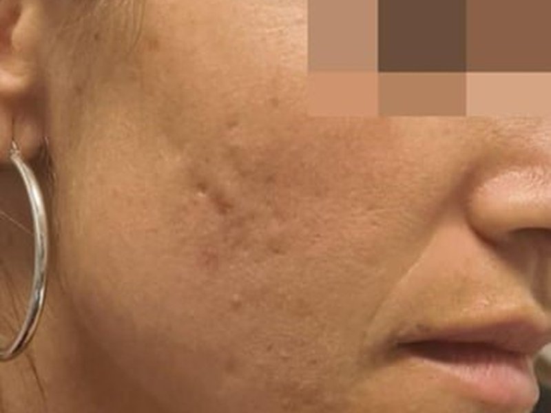 Микроигольчатый RF на Body Shape RF 311