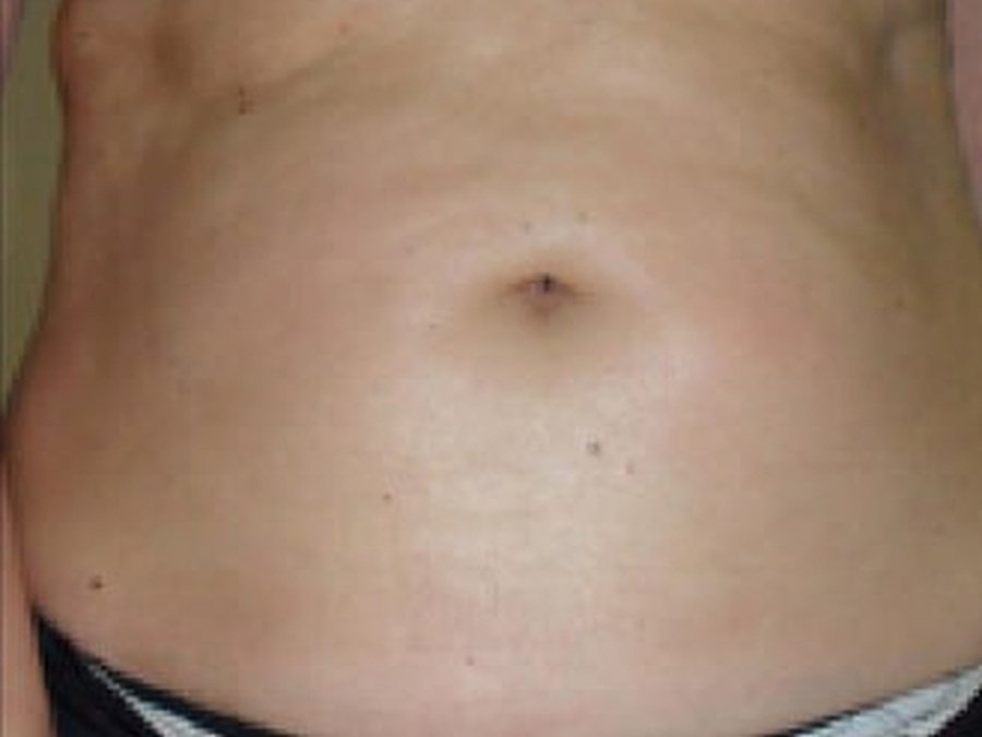 RF по телу на Body Shape RF 311