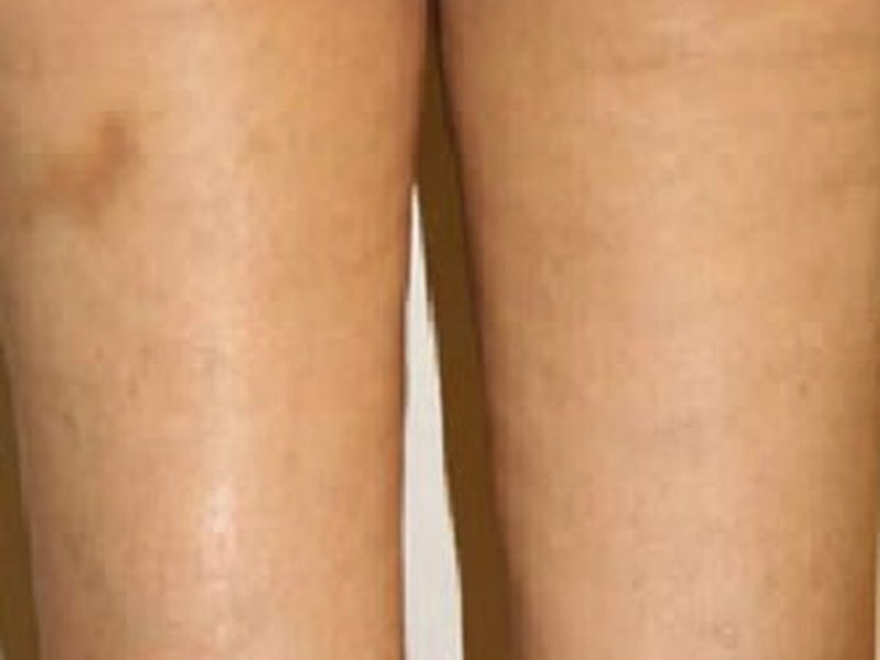 RF по телу на Body Shape RF 311