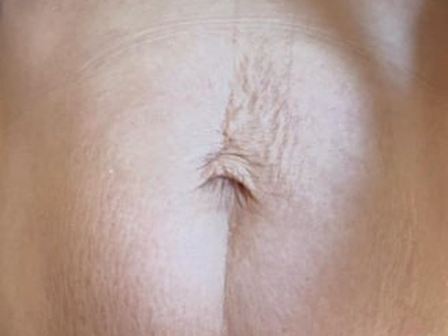 RF по телу на Body Shape RF 311