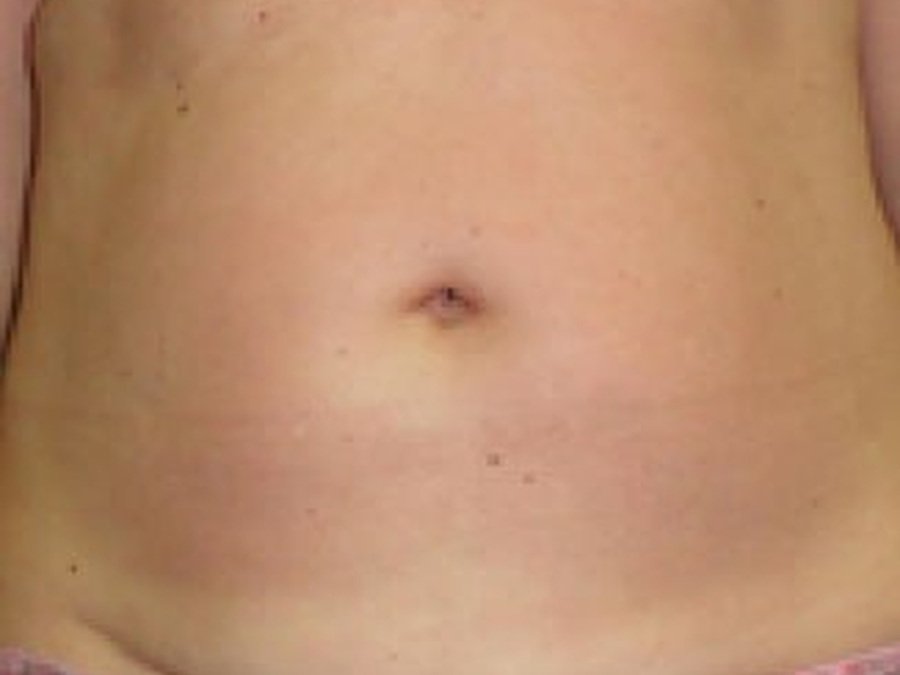 RF по телу на Body Shape RF 311