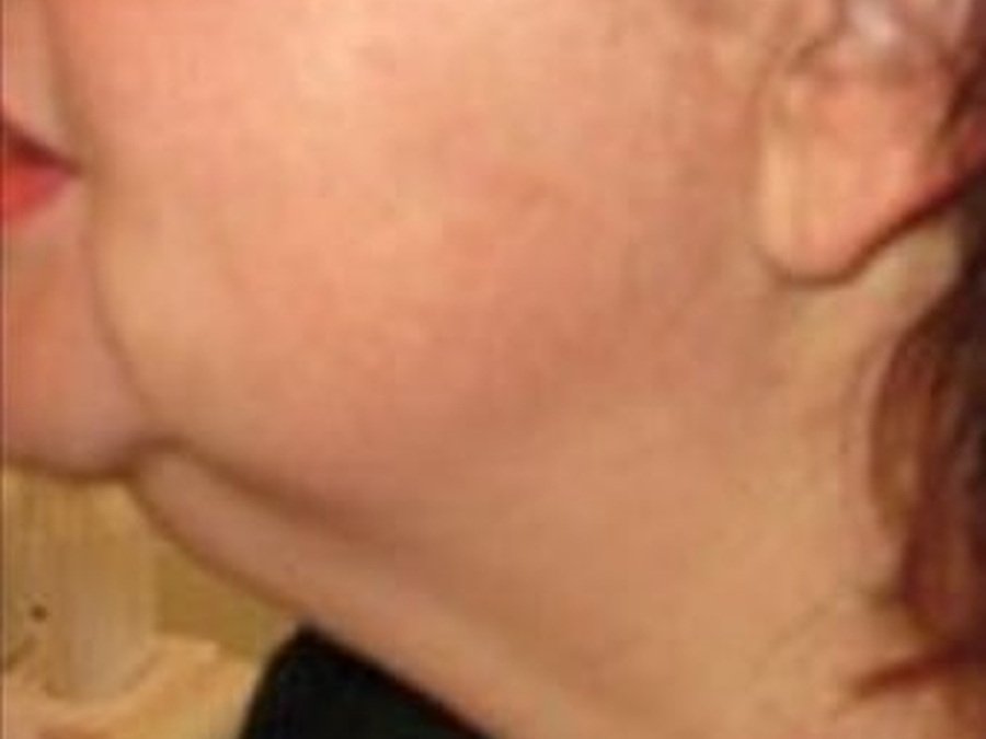 RF-лифтинг на Body Shape RF 311