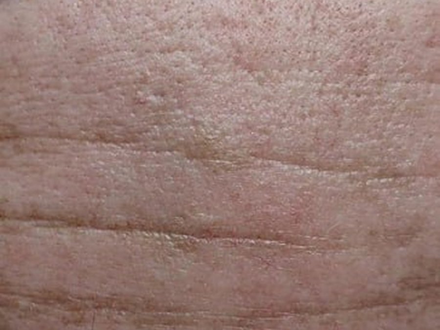 Микроигольчатый RF на Новый Body Shape