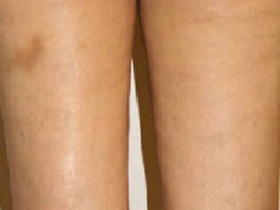 RF по телу на Новый Body Shape