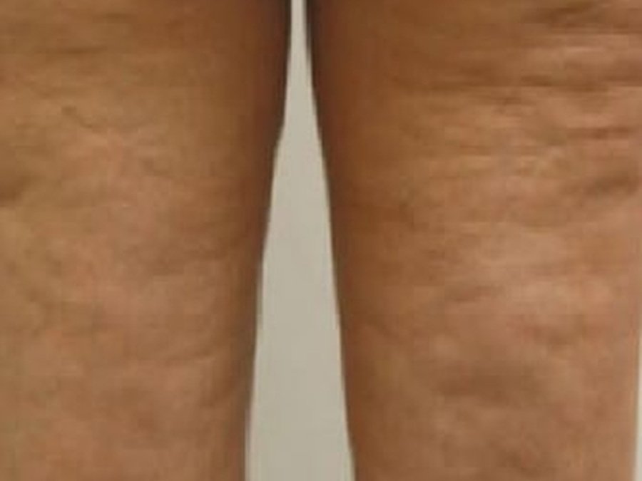 RF по телу на Новый Body Shape