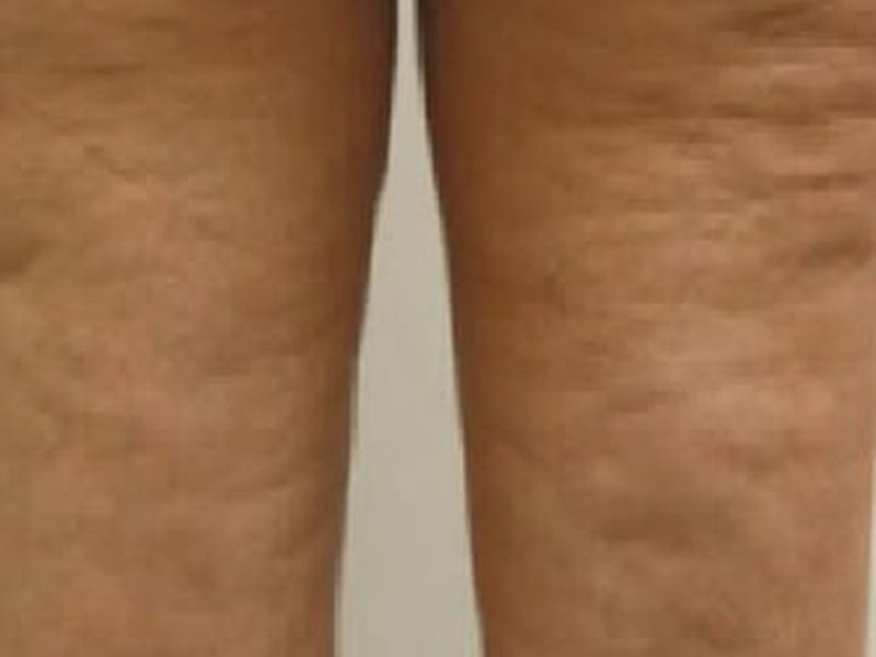 RF по телу на Новый Body Shape