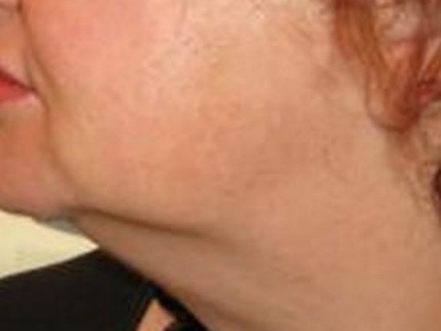 RF-лифтинг на Новый Body Shape
