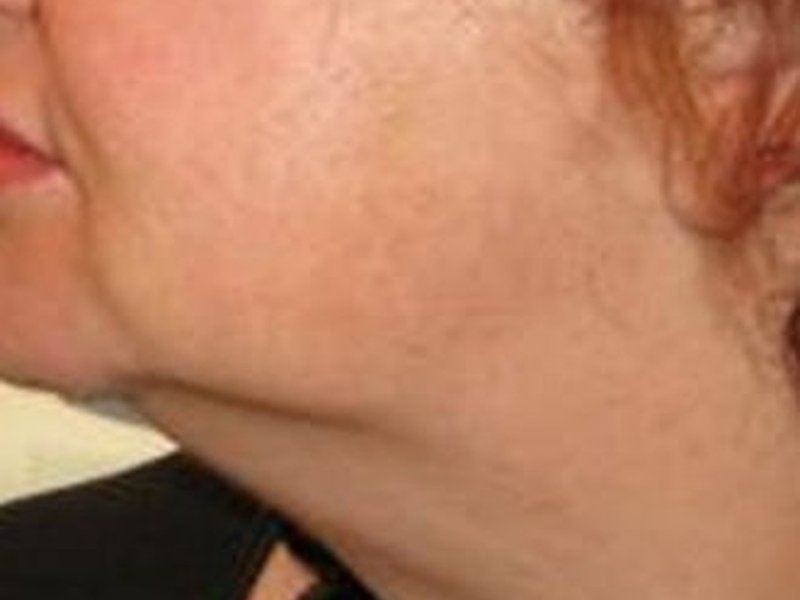 RF-лифтинг на Новый Body Shape