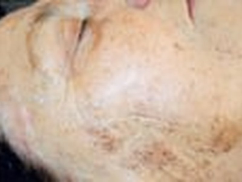Пигментация — pigmentation before