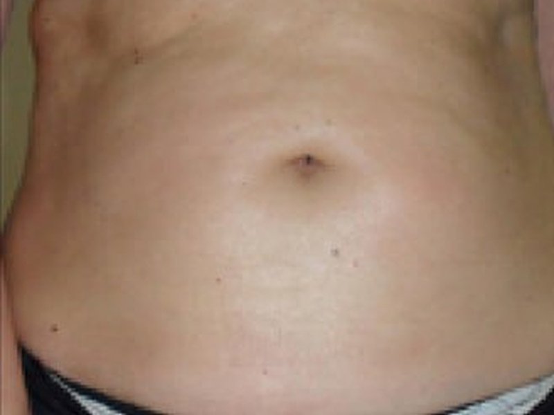 Коррекция фигуры — abdomen before
